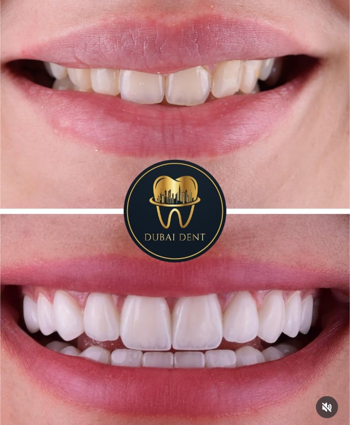 Dubai Dent smile transformation